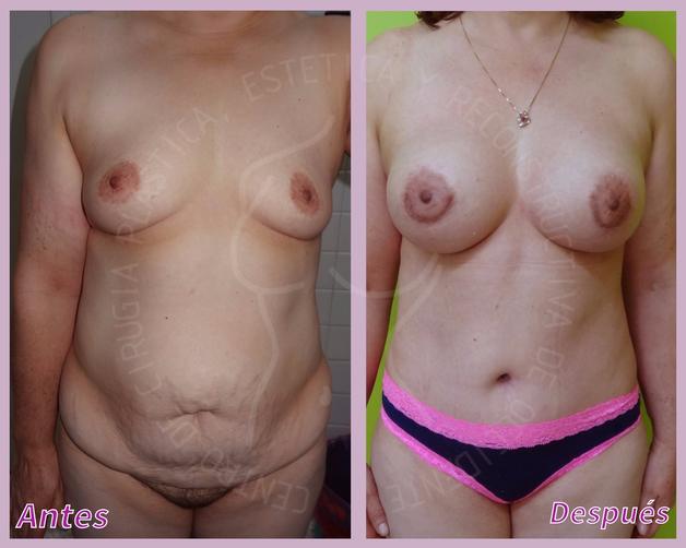 Lipoescultura + Implantes de senos + Lipectomia