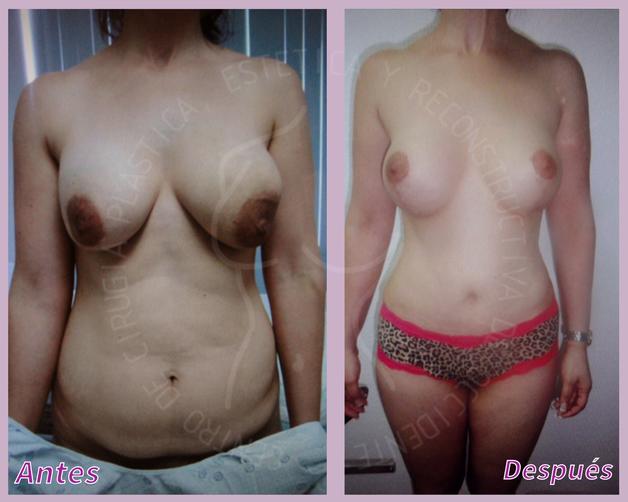 Lipoescultura + Implantes de senos + Lipectomia