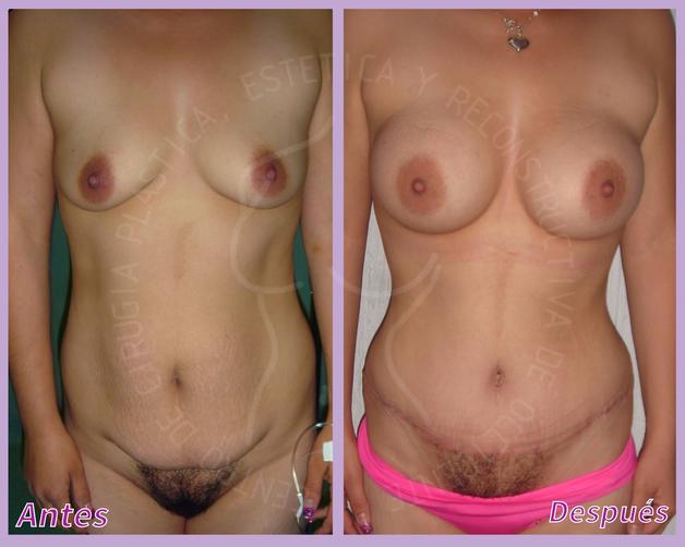 Lipoescultura + Implantes de senos + Lipectomia