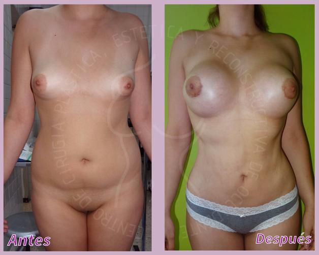 Lipoescultura + Implantes de senos + Lipectomia