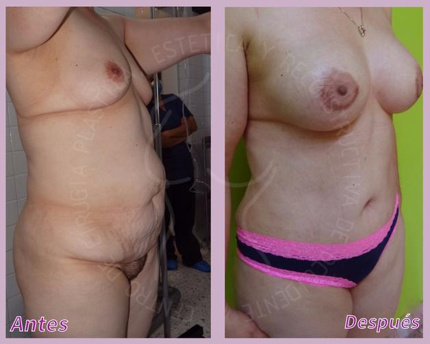 Lipoescultura + Implantes de senos + Lipectomia